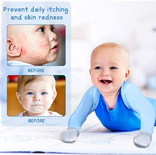 No Scratch Eczema Gloves