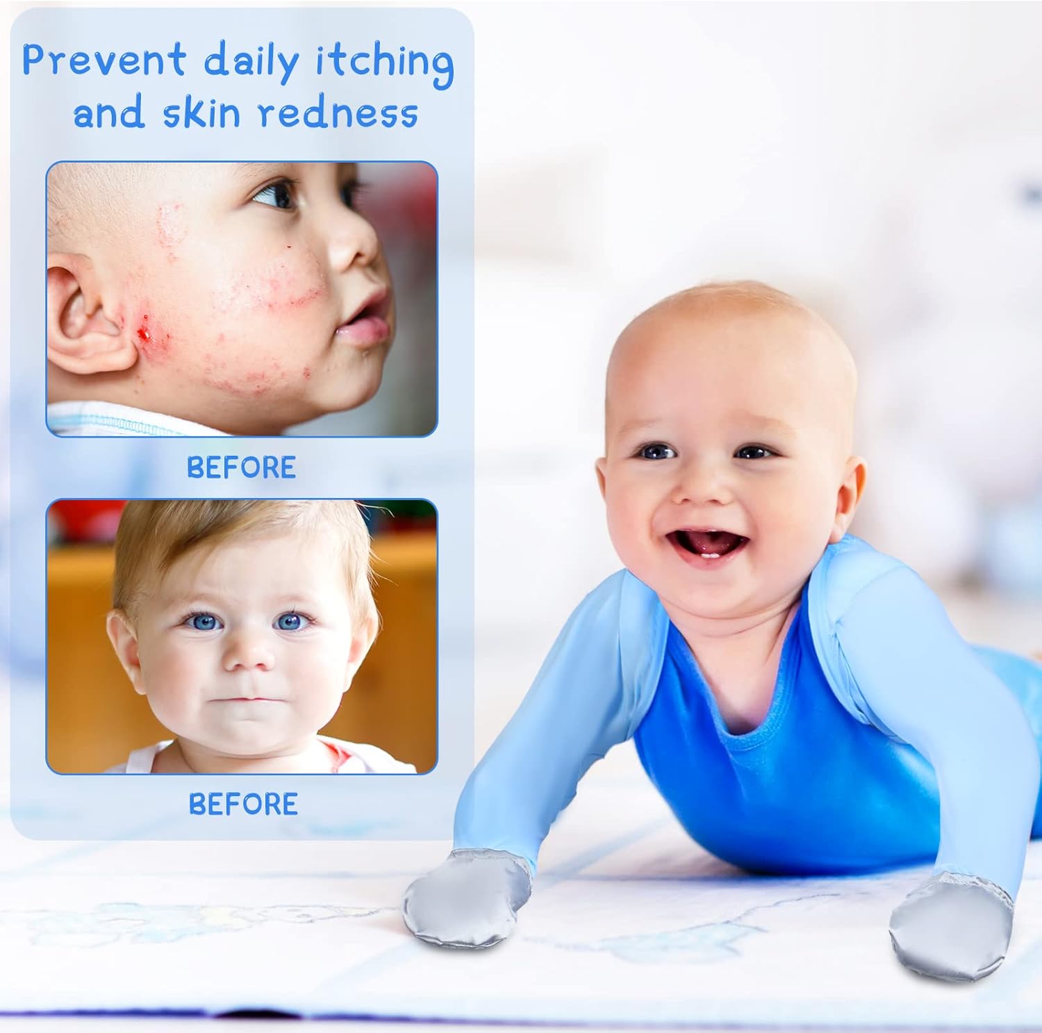 No Scratch Eczema Gloves